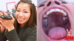 安里泉的牙齒/嘴巴自拍照：驚人的矯正牙齒