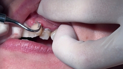 業餘魯米（34）的牙科治療影片（第一次：口腔特寫）*這是同名作品，僅包含口腔內部特寫！