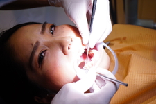 素人まことさんのリアル歯科治療映像　（１回目）