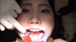 아마추어 마코토의 실제 치과 치료 영상 (3 번째)
