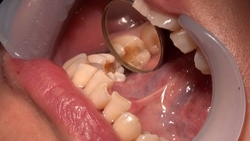 素人るみさんの歯科治療映像（２回目：口内接写映像）※ 同タイ
