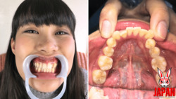 篠岬ことみちゃんの歯観察：歯ブラシ、開口器、知覚過敏！！