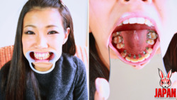 牙齿观察：我正在进行牙齿矫正 Izumi Asato
